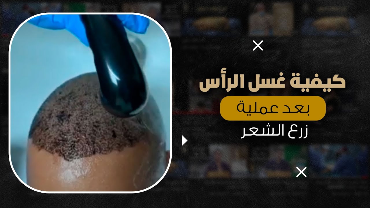كيفية غسل الرأس بعد عملية زرع الشعر