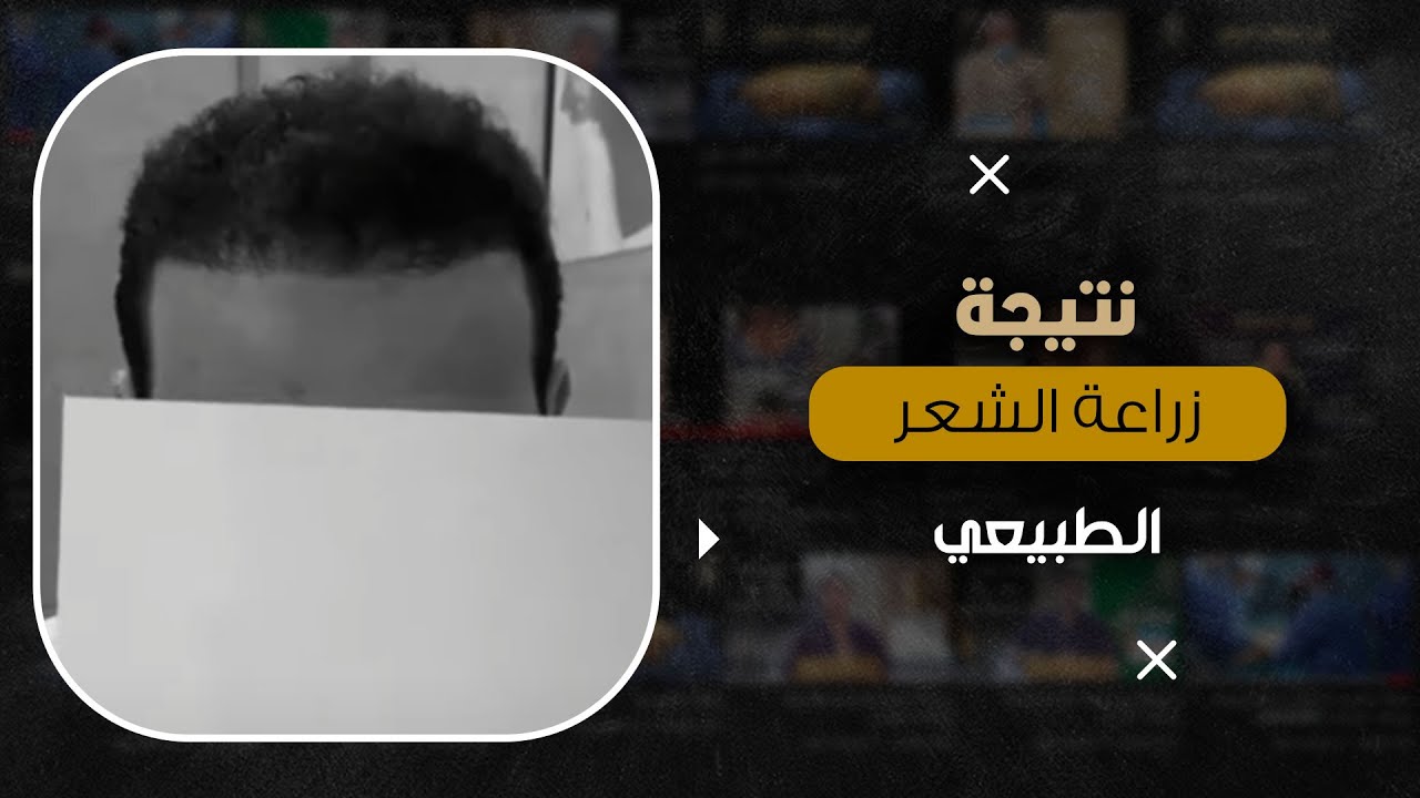 نتيجة زراعة الشعر الطبيعي بعد 6 شهور