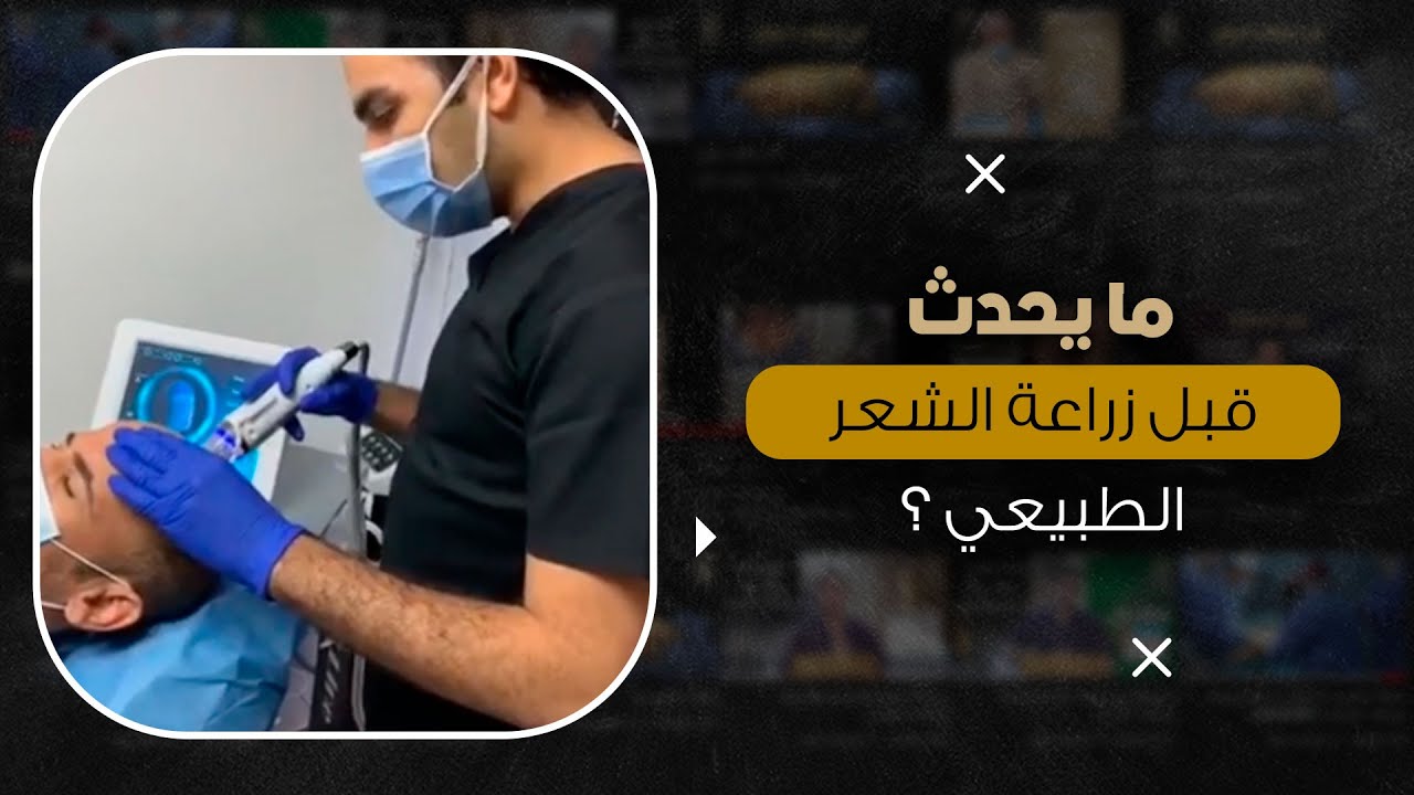 ما يحدث قبل زراعة الشعر