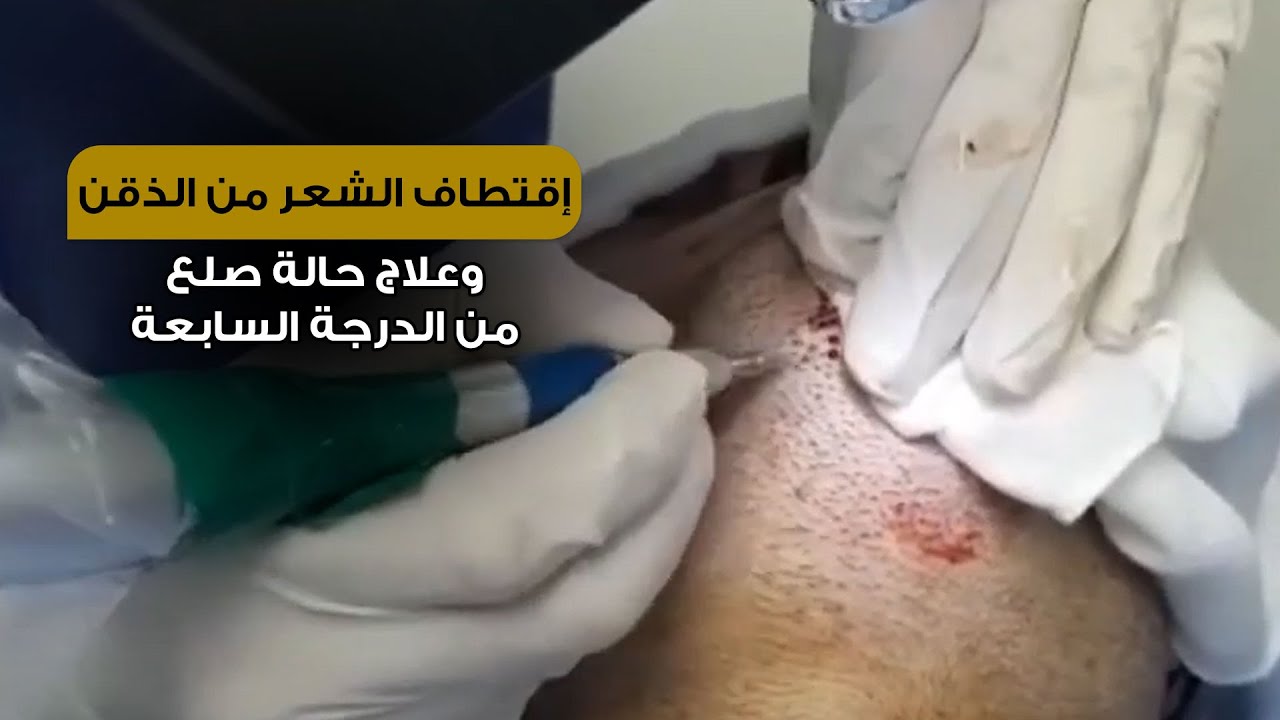 إقتطاف الشعر من الذقن وعلاج حالة صلع من الدرجة السابعة