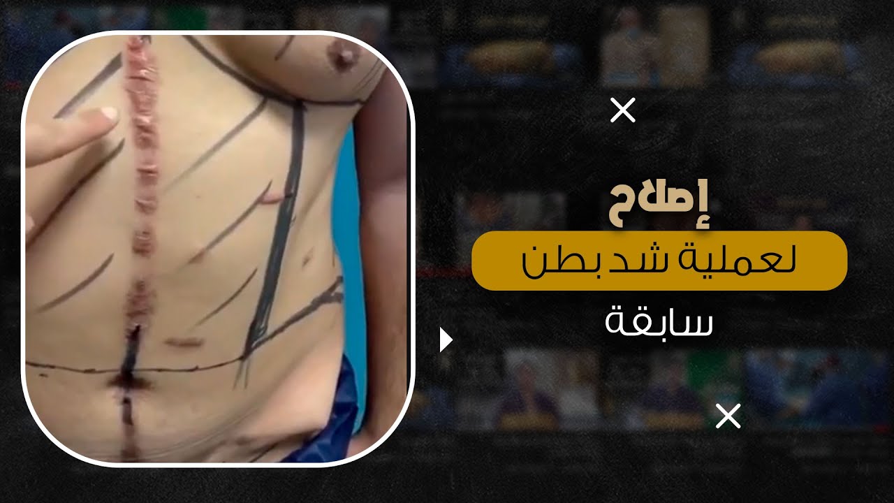 طريقة شفط الدهون بدون ألم