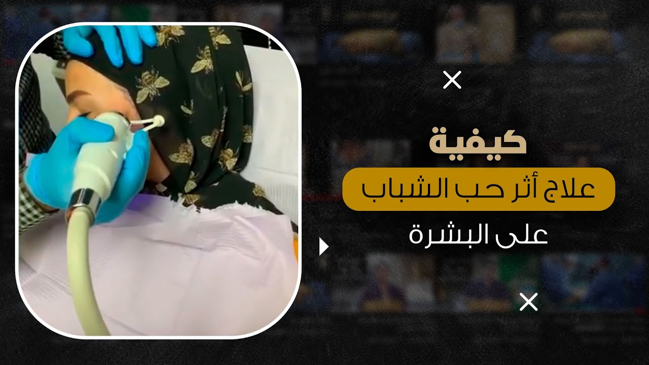 كيفية علاج آثار حب الشباب