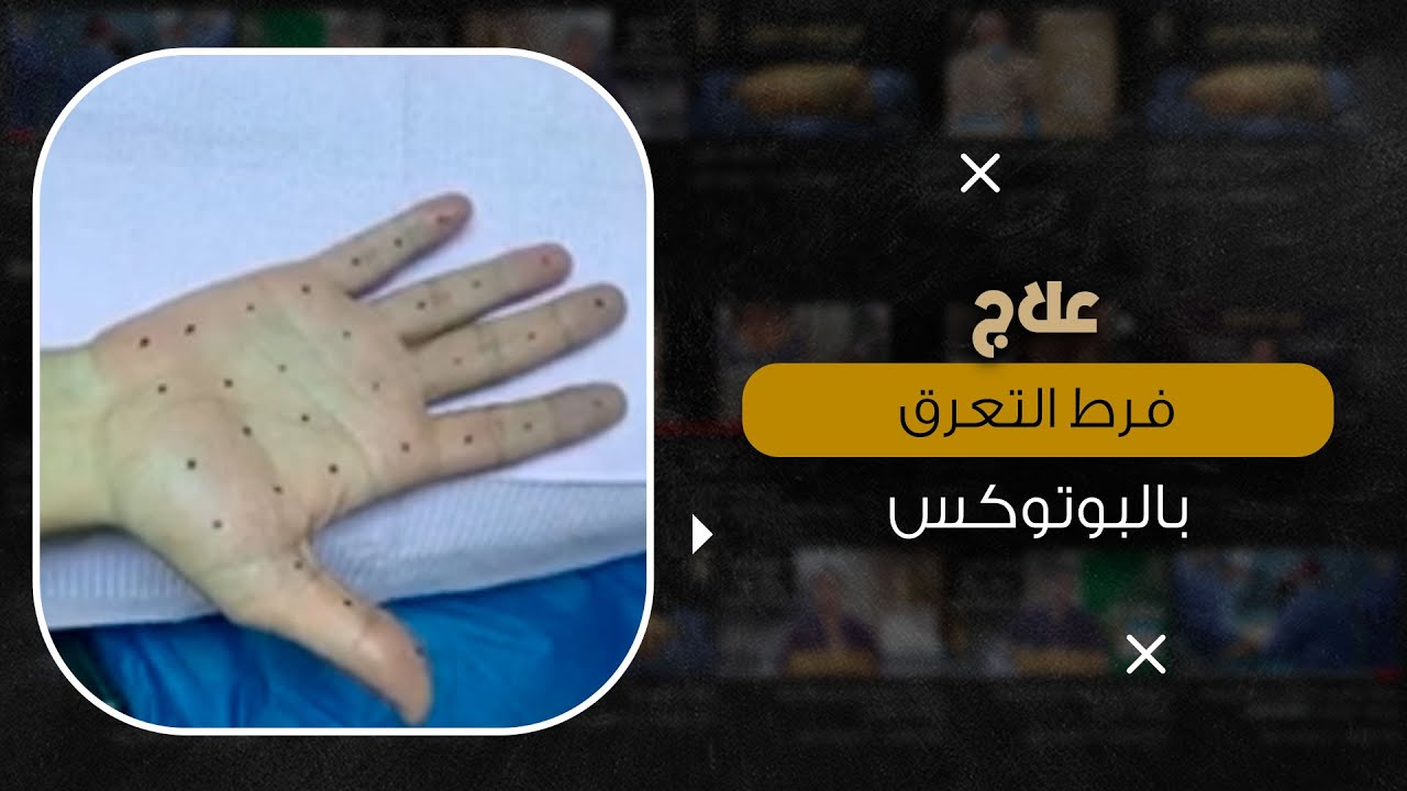 علاج فرط التعرق بالبوتوكس