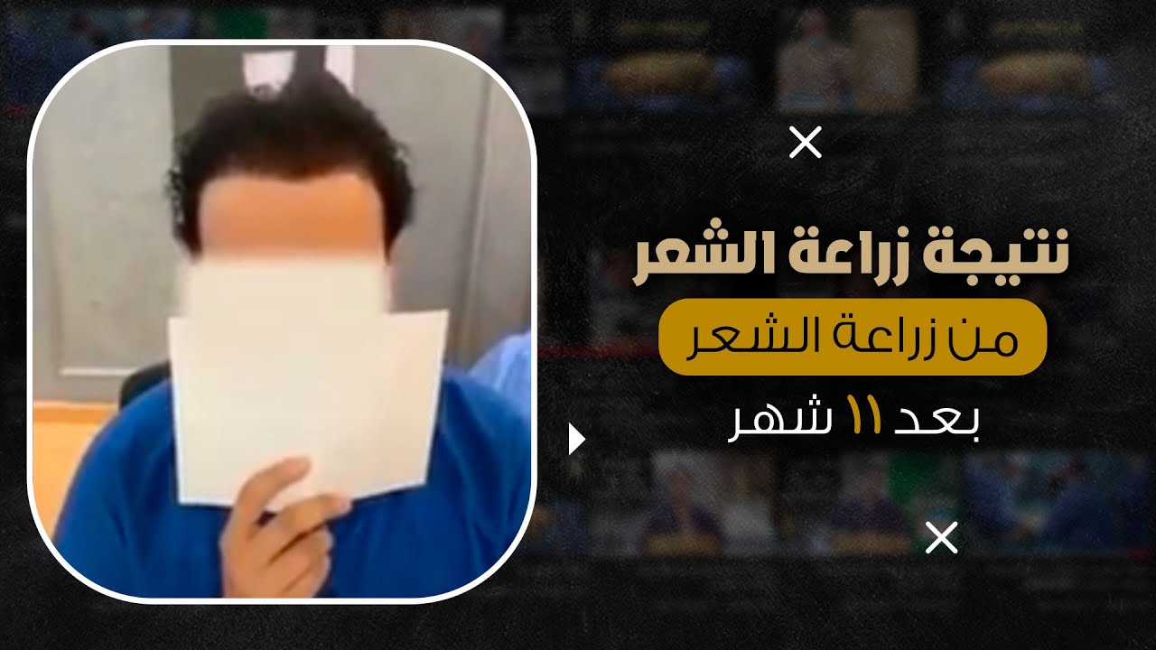 نتيجة زراعة الشعر الطبيعي لحالة صلع من الدرجة الخامسة بعد 11 شهر