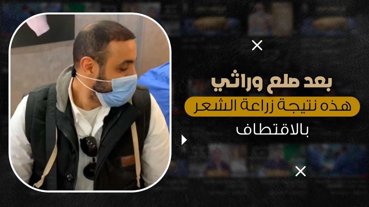 علاج الصلع الوراثي بزراعة شعر طبيعي 100% شاهد النتيجة مباشرة من داخل العمليات