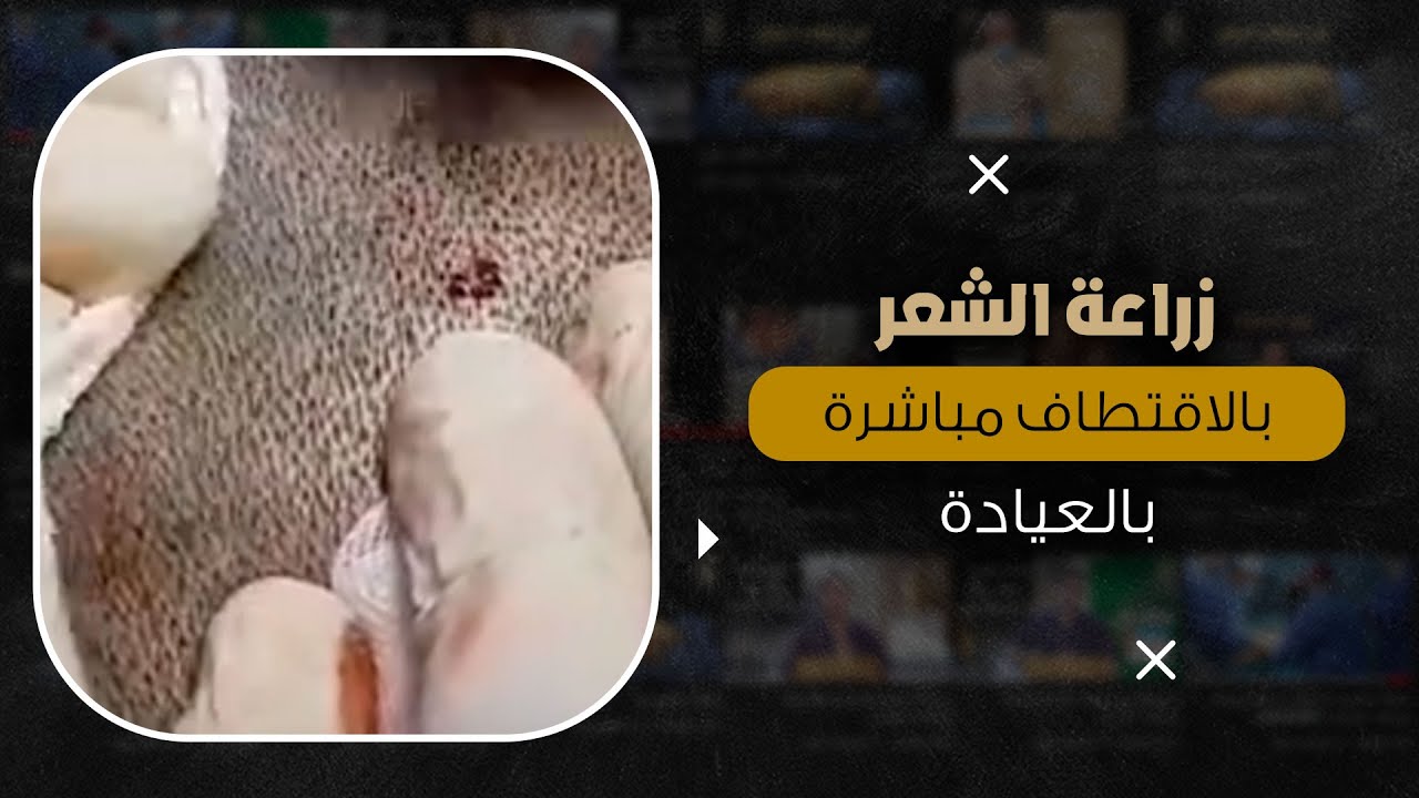 زراعة الشعر بالاقتطاف في عياداتنا