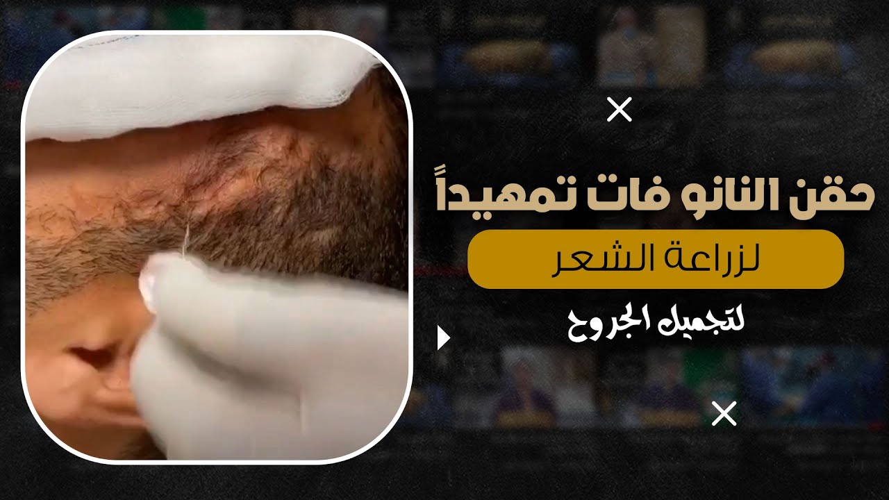 حقن النانو فات تمهيداً لزراعة الشعر للجروح