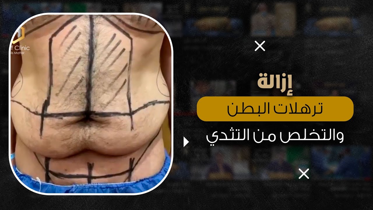 عملية شفط دهون البطن شاهد النتيجة مباشرة من داخل العمليات