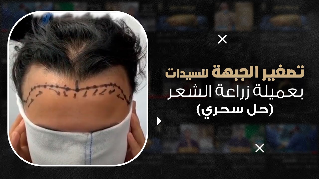 تصغير الجبهة للسيدات عن طريق زراعة الشعر (حل سحري)