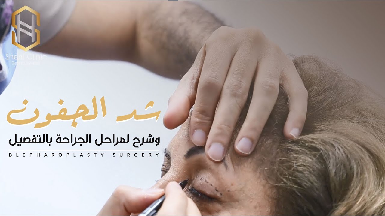 شد الجفون وشرح لمراحل العميلة بالتفصيل