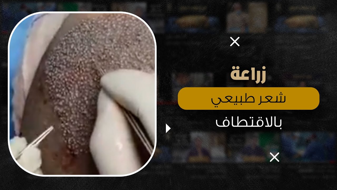 زراعة شعر طبيعي بالاقتطاف