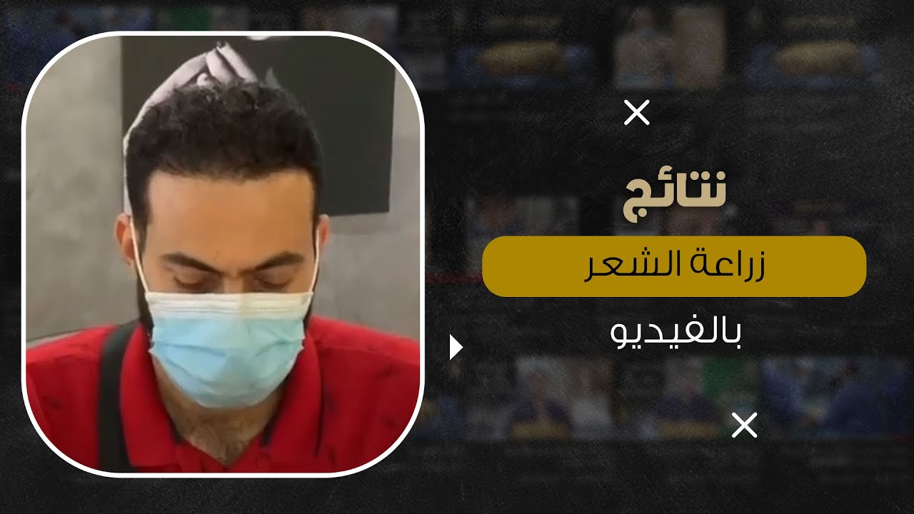 نتائج زراعة الشعر بالفيديو