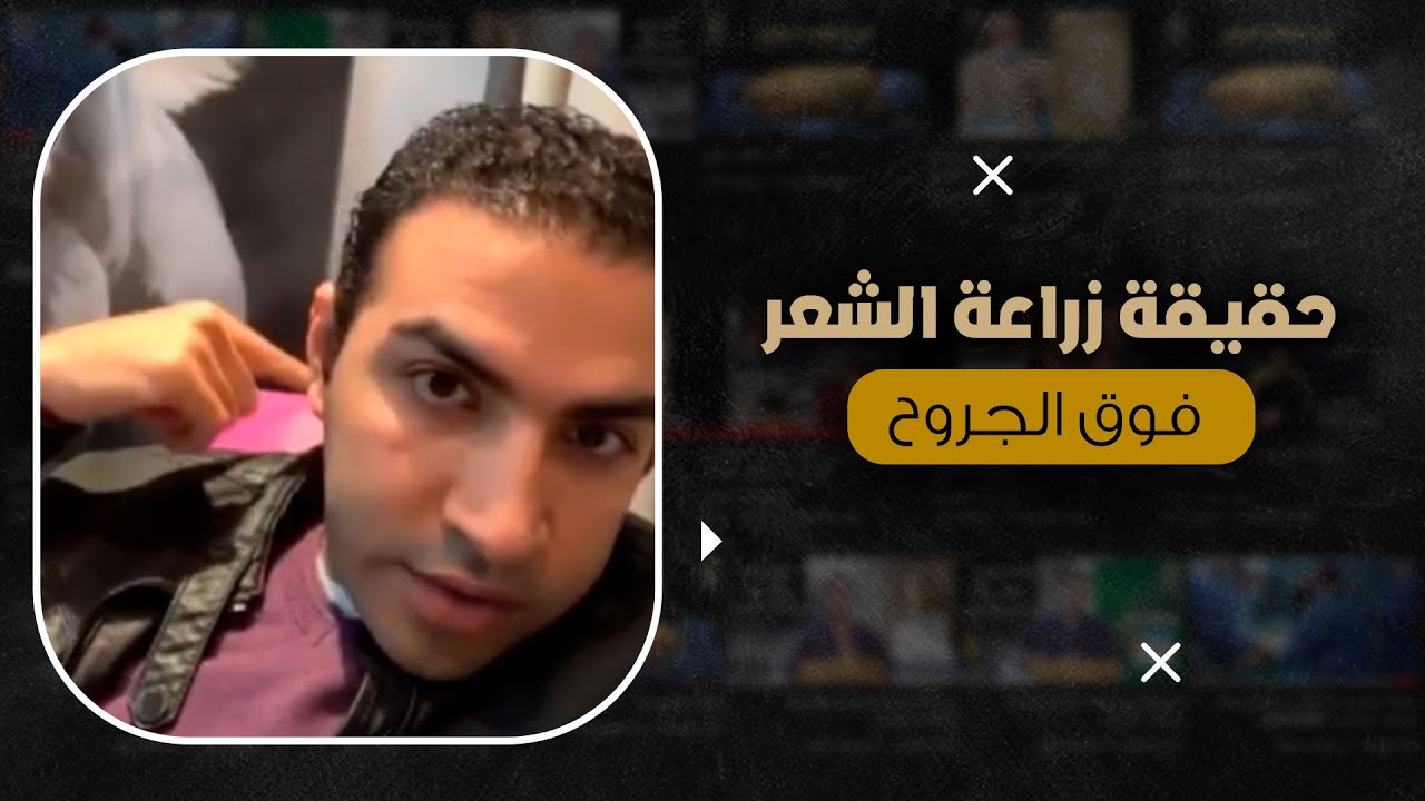 حقيقة زراعة الشعر فوق الجروح و الحروق