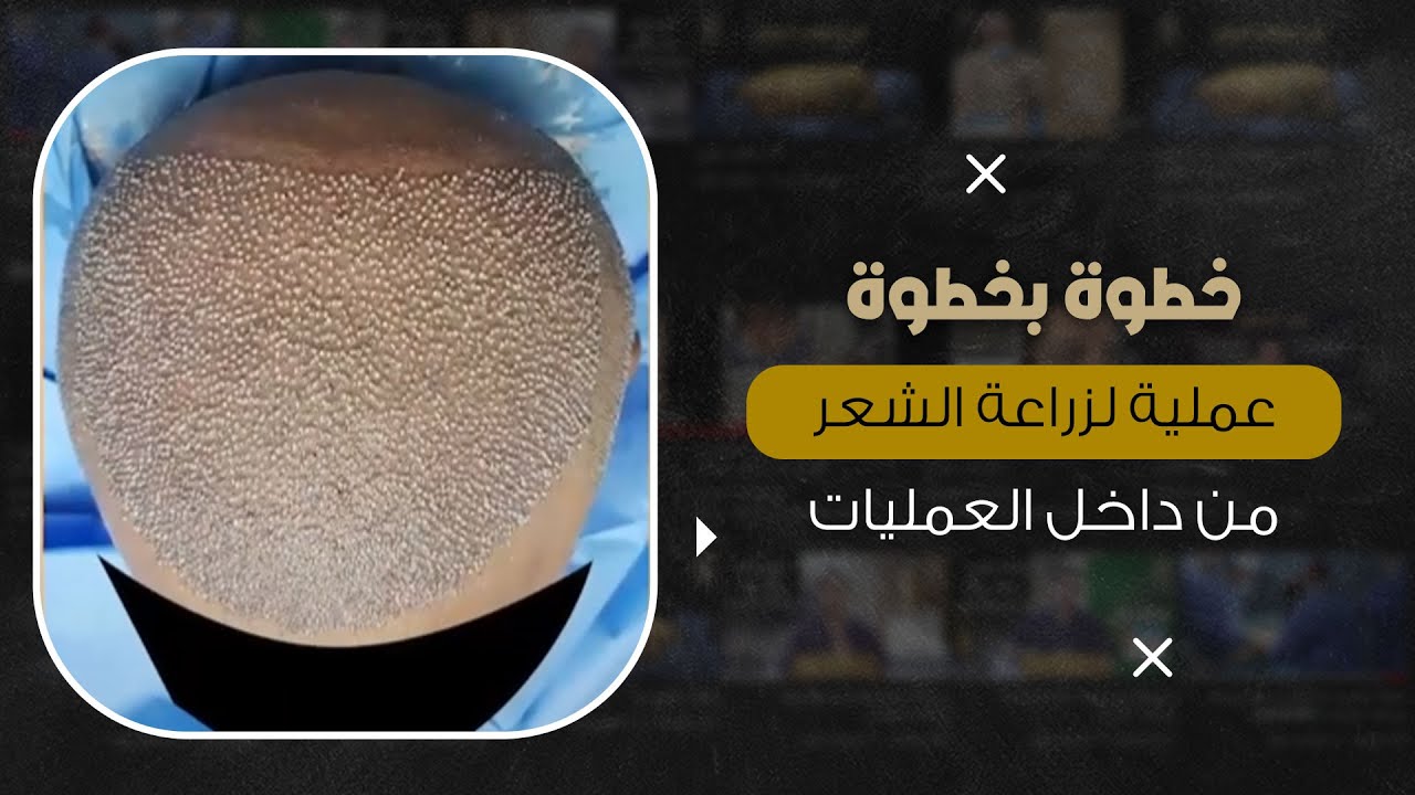 خطوة بخطوة عملية زراعة الشعر الطبيعي