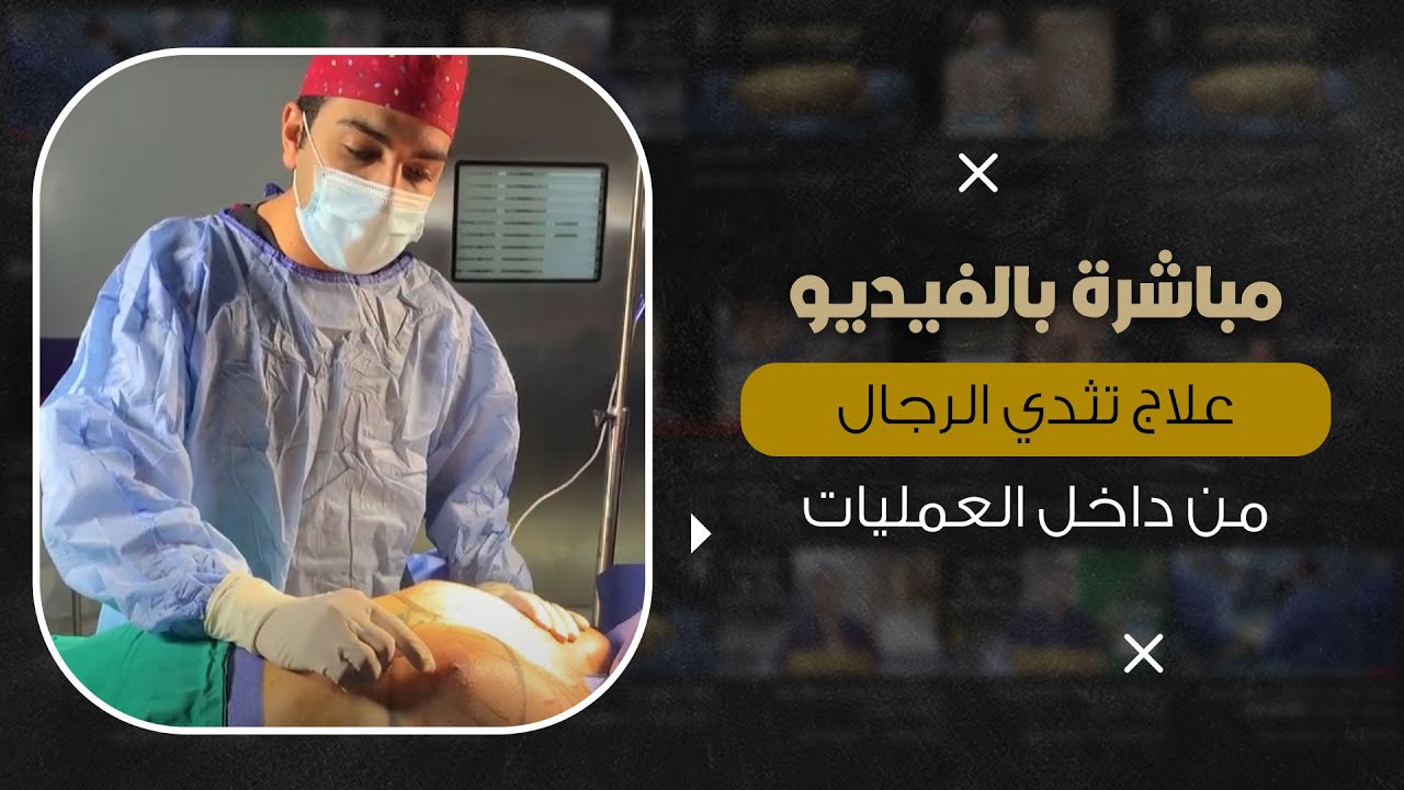 مباشرة علاج التثدي للرجال من داخل العمليات