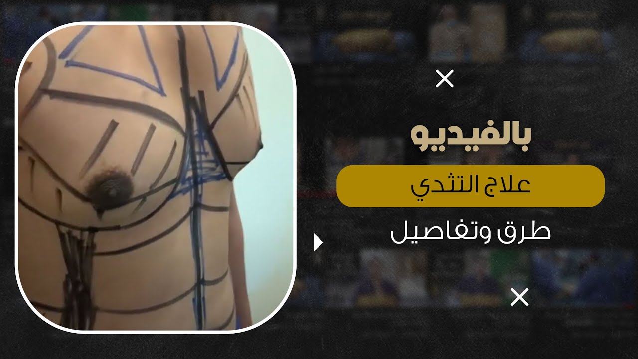 تفاصيل طرق علاج التثدي