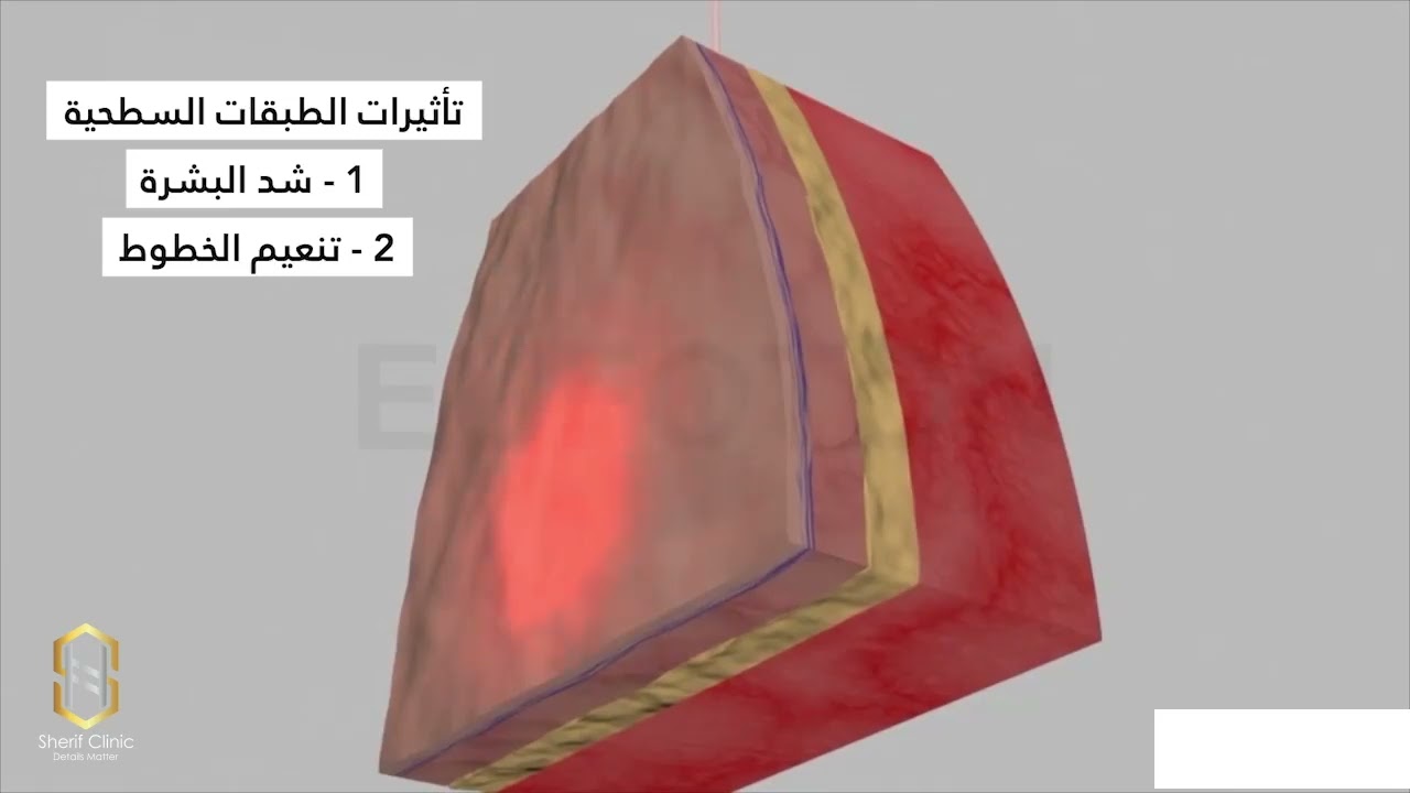 ازاي بيشتغل ؟ - Endolift