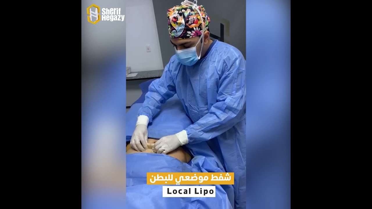 جلسة شفط موضعي للدهون بالتخدير الموضعي