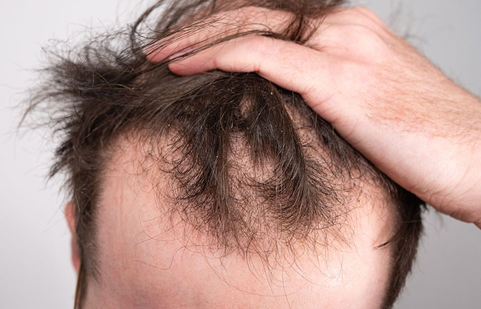 أنواع زراعة الشعر