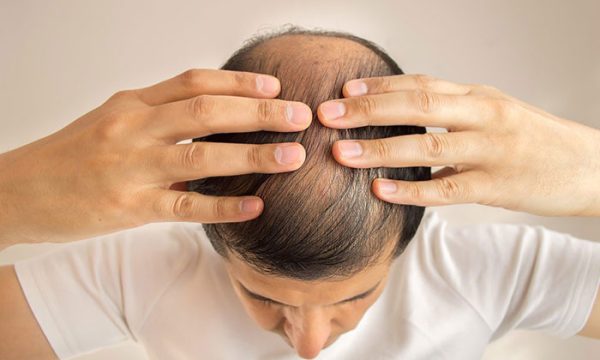 زراعة الشعر الصناعي