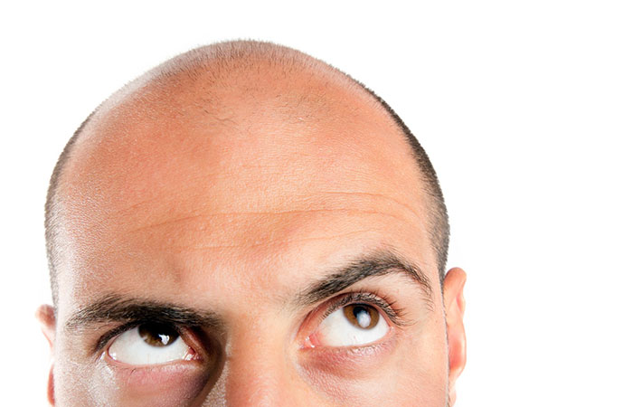 شروط زراعة الشعر