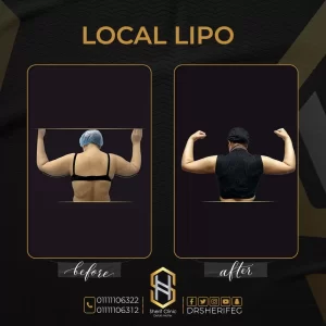 كم كيلو ينزل بعد عملية شفط الدهون