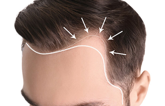 احدث تقنيات زراعة الشعر