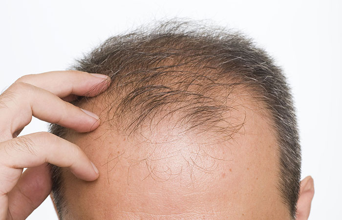 احدث تقنية لزراعة الشعر