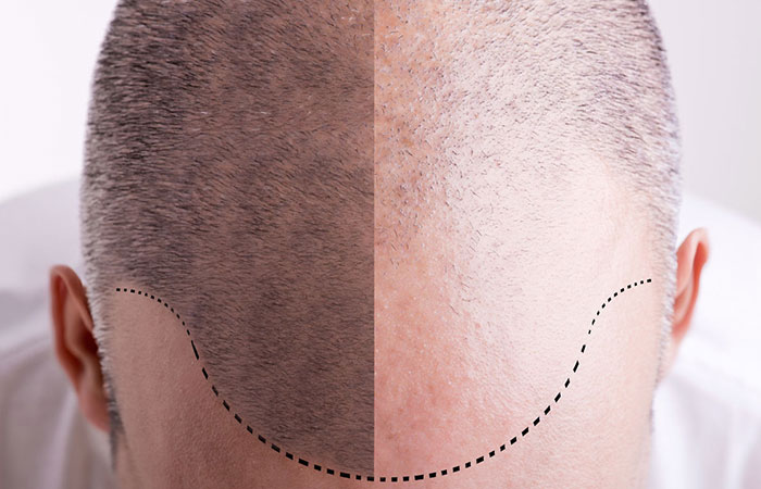 احدث طرق زراعة الشعر