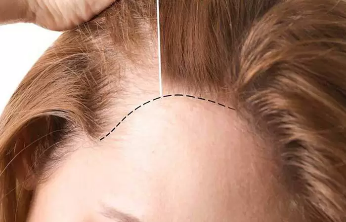 تجربتي في زراعة الشعر للنساء