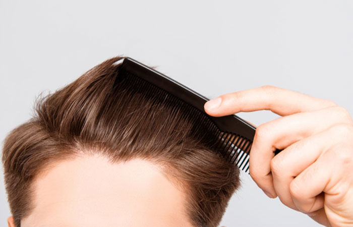 تجربتي مع زراعة الشعر بالصور