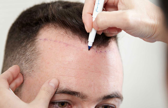 تقنية fue لزراعة الشعر