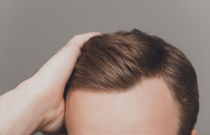 زراعة الشعر بالليزر