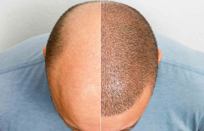 زراعة الشعر من متبرع