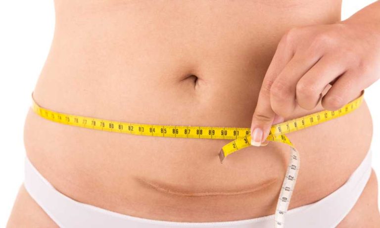علاج ترهلات البطن بعد القيصرية