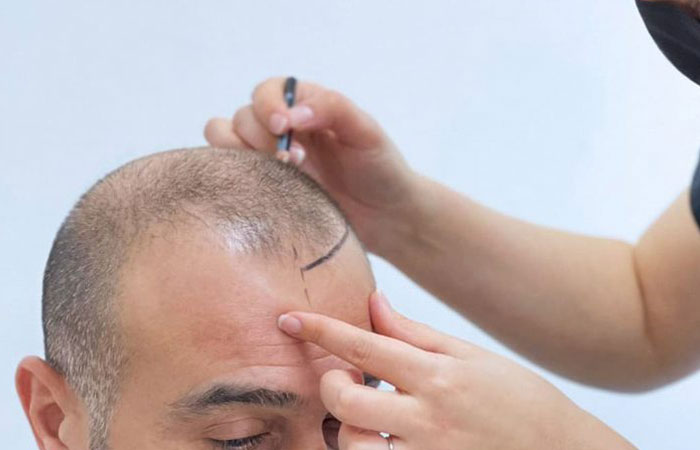 عيادة زراعة الشعر