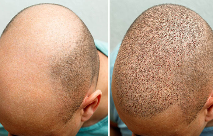 كيف يتم زراعة الشعر