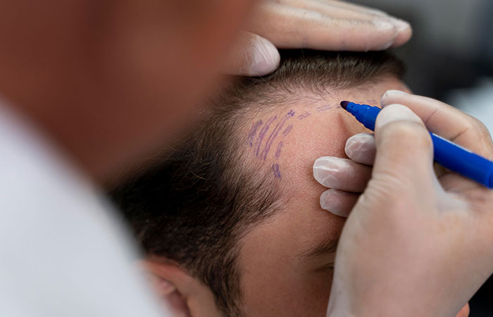 مراكز زراعة الشعر