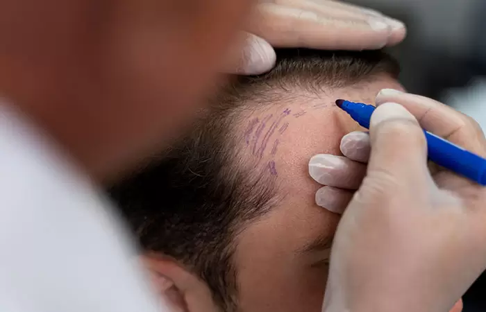 مراكز زراعة الشعر