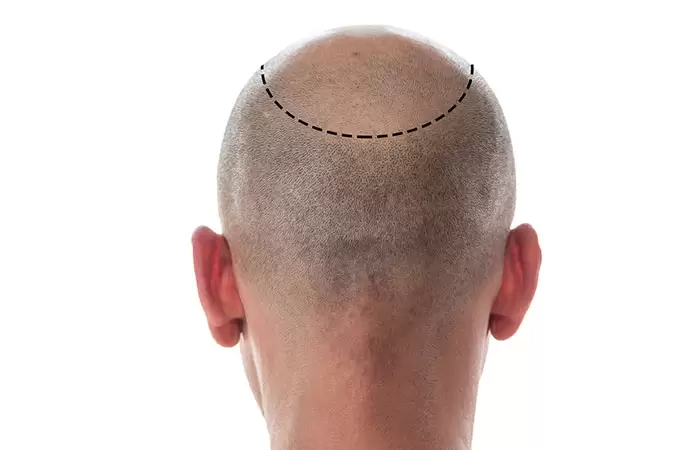 نتائج زراعة الشعر بالصور
