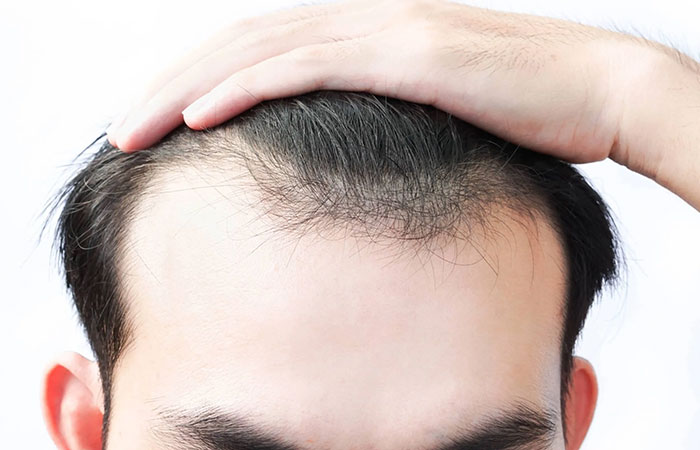 افضل طريقة لزراعة الشعر