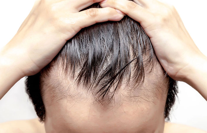 العمر المناسب لزراعة الشعر