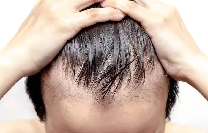 العمر المناسب لزراعة الشعر