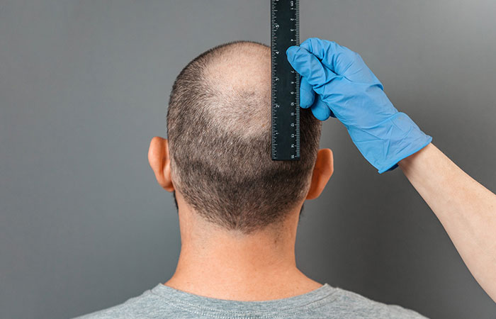 تجارب زراعة الشعر