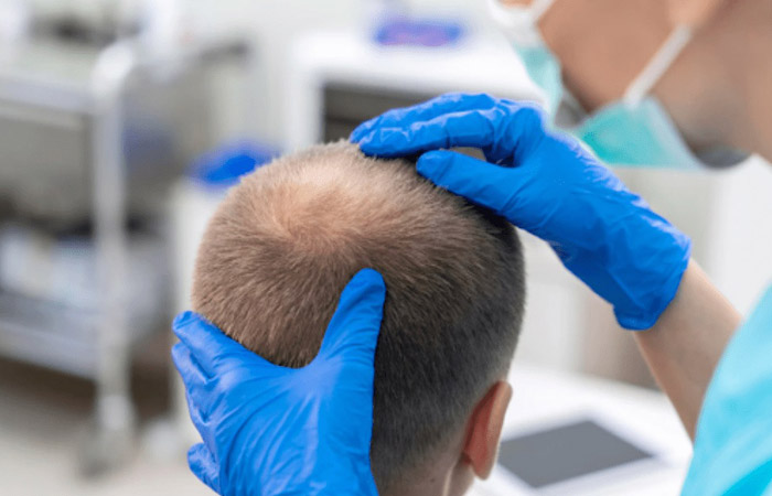 تقنية dhi لزراعة الشعر