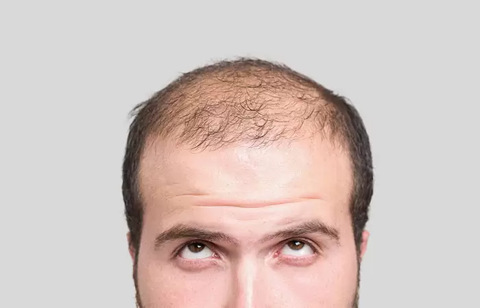 دكتور زراعة الشعر