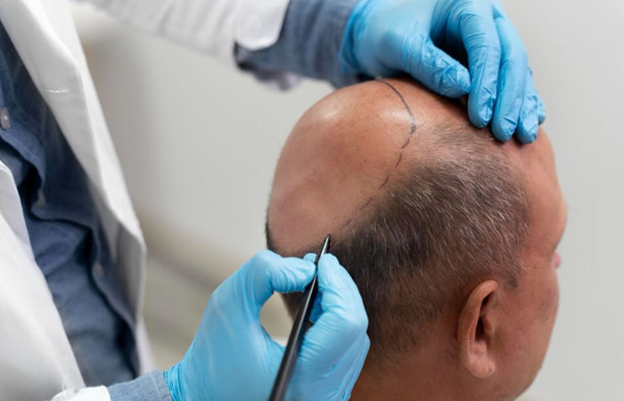 زراعة الشعر بتقنية السفير