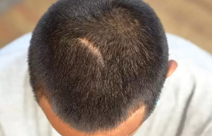 زراعة الشعر مكان الخياطة