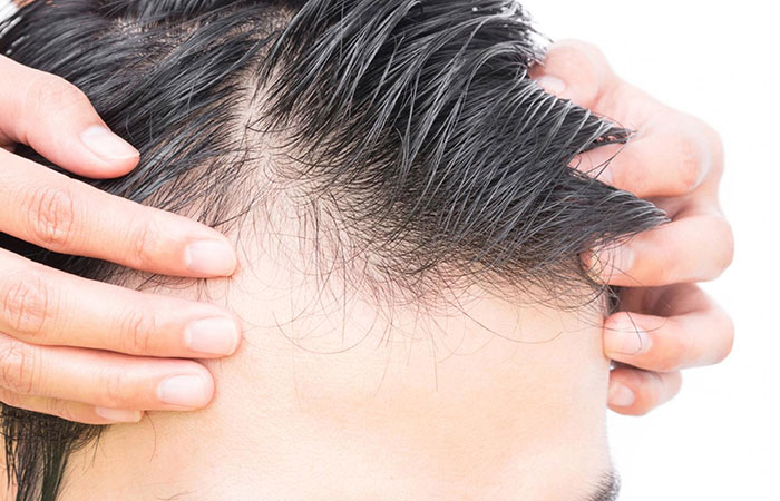 زراعة شعر صناعي