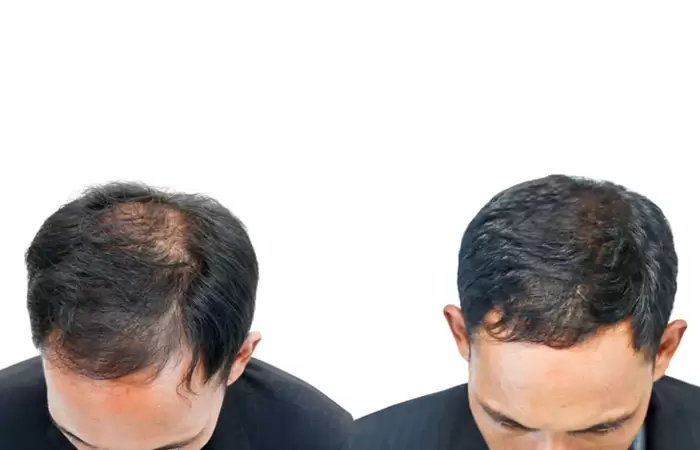 صور زراعة الشعر